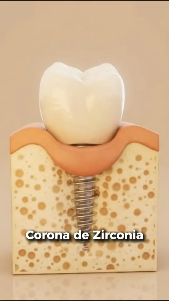 Video sobre implantes dentales en IDental